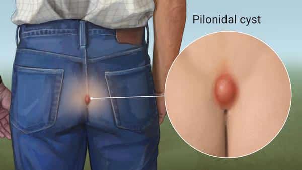 Doctor reccomend Painful pimples around my ass hole