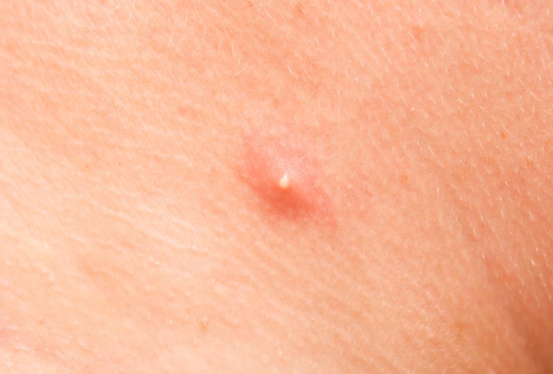 Crisp reccomend Small lump and freckles on anus